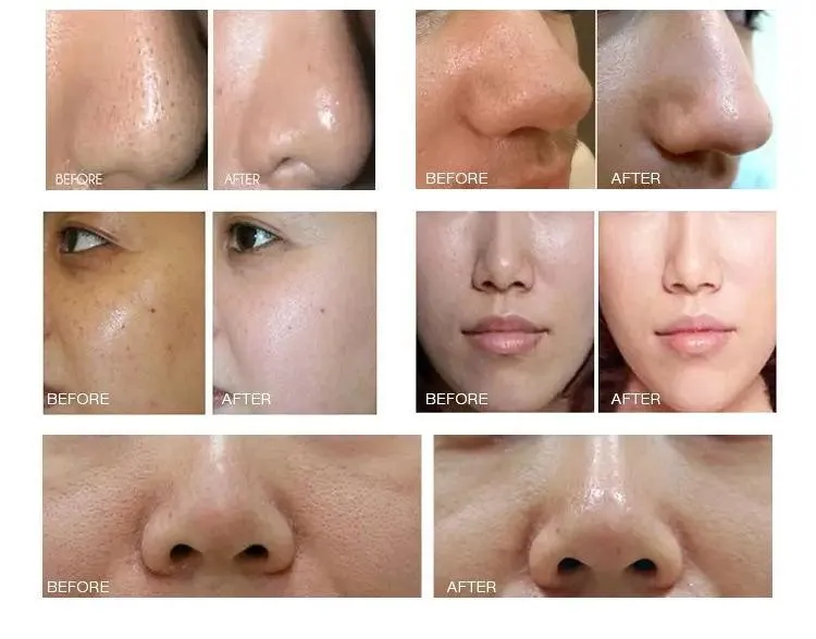 7 in 1 Skin Peeling Hydro Microdermabrasion Machine